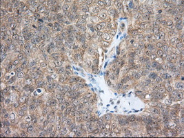 ACAT2 Antibody - IHC of paraffin-embedded Adenocarcinoma of Human ovary tissue using anti-ACAT2 mouse monoclonal antibody. (Dilution 1:50).