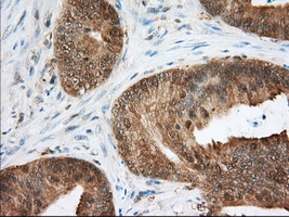 ACAT2 Antibody - IHC of paraffin-embedded Adenocarcinoma of Human colon tissue using anti-ACAT2 mouse monoclonal antibody. (Dilution 1:50).