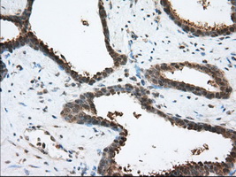 ACAT2 Antibody - IHC of paraffin-embedded Carcinoma of Human prostate tissue using anti-ACAT2 mouse monoclonal antibody. (Dilution 1:50).