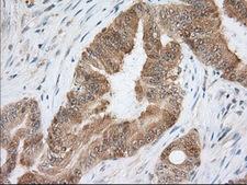 ACAT2 Antibody - IHC of paraffin-embedded Adenocarcinoma of Human colon tissue using anti-ACAT2 mouse monoclonal antibody. (Dilution 1:50).