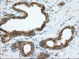 ACAT2 Antibody - IHC of paraffin-embedded Carcinoma of Human prostate tissue using anti-ACAT2 mouse monoclonal antibody. (Dilution 1:50).