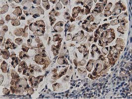 ACAT2 Antibody - IHC of paraffin-embedded Adenocarcinoma of Human colon tissue using anti-ACAT2 mouse monoclonal antibody.
