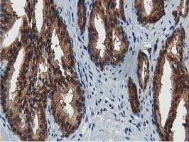 ACAT2 Antibody - IHC of paraffin-embedded Carcinoma of Human prostate tissue using anti-ACAT2 mouse monoclonal antibody.