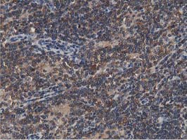 ACAT2 Antibody - IHC of paraffin-embedded Human lymphoma tissue using anti-ACAT2 mouse monoclonal antibody.