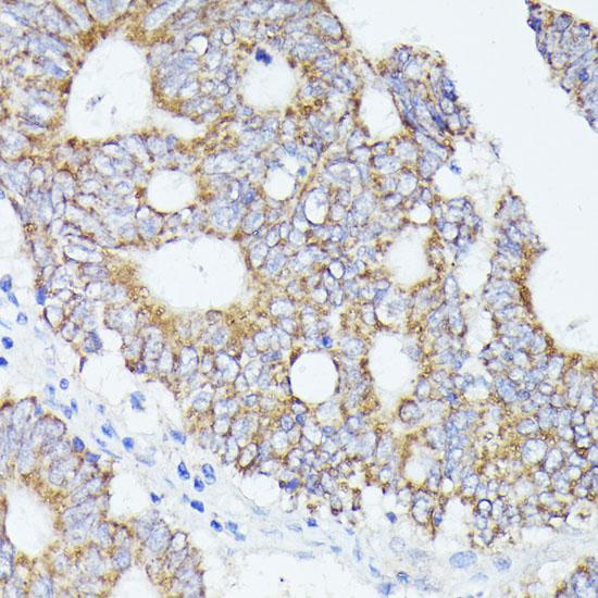 ACAT2 Antibody - Immunohistochemistry of paraffin-embedded Human colon carcinoma using ACAT2 Polyclonal Antibody at dilution of 1:100 (40x lens).