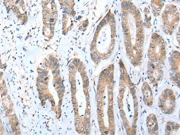 ACBD4 Antibody - Immunohistochemistry of paraffin-embedded Human gastric cancer tissue  using ACBD4 Polyclonal Antibody at dilution of 1:30(×200)