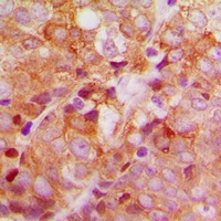 ACBD6 Antibody - Immunohistochemical analysis of ACBD6 staining in human breast cancer formalin fixed paraffin embedded tissue section. The section was pre-treated using heat mediated antigen retrieval with sodium citrate buffer (pH 6.0). The section was then incubated with the antibody at room temperature and detected with HRP and DAB as chromogen. The section was then counterstained with hematoxylin and mounted with DPX.