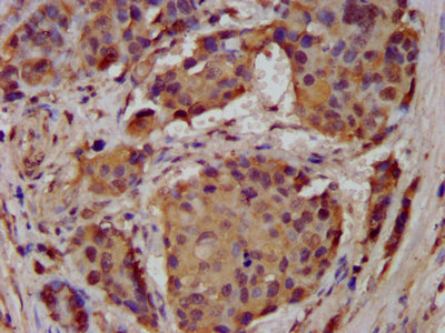 ACCN1 / ASIC2 Antibody - Immunohistochemistry image at a dilution of 1:300 and staining in paraffin-embedded human pancreatic cancer performed on a Leica BondTM system. After dewaxing and hydration, antigen retrieval was mediated by high pressure in a citrate buffer (pH 6.0) . Section was blocked with 10% normal goat serum 30min at RT. Then primary antibody (1% BSA) was incubated at 4 °C overnight. The primary is detected by a biotinylated secondary antibody and visualized using an HRP conjugated SP system.