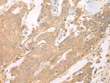 ACCN3 / ASIC3 Antibody - Immunohistochemistry of paraffin-embedded Human colorectal cancer tissue  using ASIC3 Polyclonal Antibody at dilution of 1:40(×200)