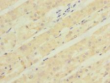 ACCN5 / HINAC Antibody - Immunohistochemistry of paraffin-embedded human gastric cancer at dilution 1:100