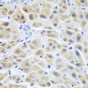 ACCS / ACS Antibody - Immunohistochemistry of paraffin-embedded human liver cancer using ACCS antibody at dilution of 1:200 (40x lens).