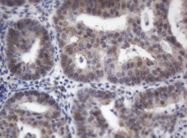 ACD / PTOP Antibody - IHC of paraffin-embedded Adenocarcinoma of Human endometrium tissue using anti-ACD mouse monoclonal antibody.