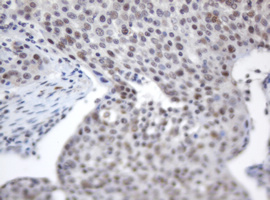 ACD / PTOP Antibody - IHC of paraffin-embedded Carcinoma of Human bladder tissue using anti-ACD mouse monoclonal antibody.