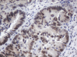ACD / PTOP Antibody - IHC of paraffin-embedded Adenocarcinoma of Human colon tissue using anti-ACD mouse monoclonal antibody.