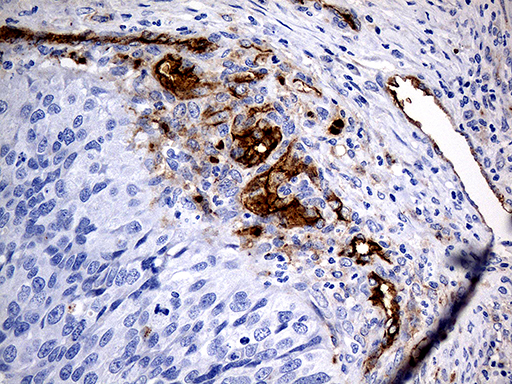 ACE / CD143 Antibody - Immunohistochemical staining of paraffin-embedded Carcinoma of Human kidney tissue using anti-ACE mouse monoclonal antibody. (Heat-induced epitope retrieval by 1mM EDTA in 10mM Tris buffer. (pH8.5) at 120°C for 3 min. (1:500)