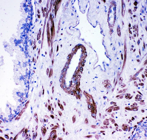 ACE / CD143 Antibody - ACE antibody IHC-paraffin: Human Prostatic Cancer Tissue.