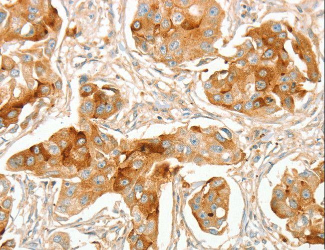 ACE / CD143 Antibody - Immunohistochemistry of paraffin-embedded Human breast cancer using ACE Polyclonal Antibody at dilution of 1:70.