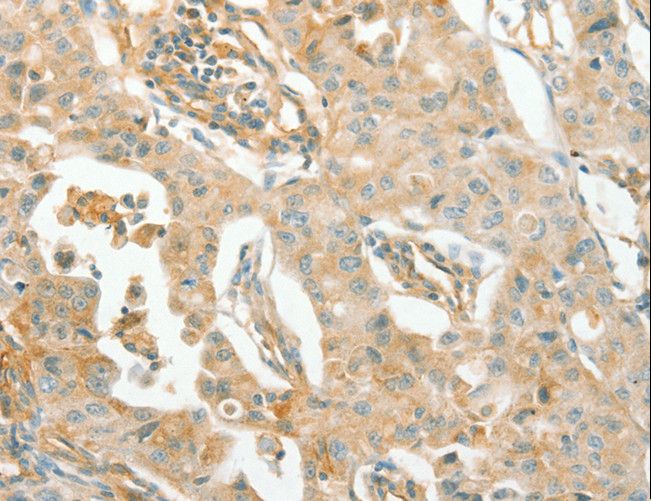 ACE / CD143 Antibody - Immunohistochemistry of paraffin-embedded Human lung cancer using ACE Polyclonal Antibody at dilution of 1:70.