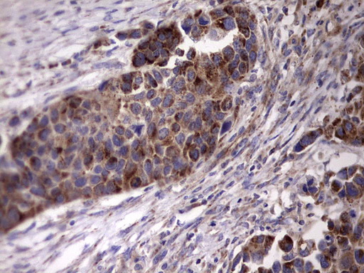 ACE2 / ACE-2 Antibody - IHC of paraffin-embedded Carcinoma of Human kidney tissue using anti-ACE2 mouse monoclonal antibody. (Heat-induced epitope retrieval by 1 mM EDTA in 10mM Tris, pH8.5, 120°C for 3min).