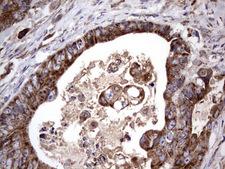 ACE2 / ACE-2 Antibody - IHC of paraffin-embedded Adenocarcinoma of Human colon tissue using anti-ACE2 mouse monoclonal antibody. (Heat-induced epitope retrieval by 1 mM EDTA in 10mM Tris, pH8.5, 120°C for 3min).