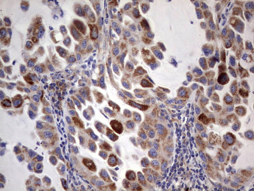 ACE2 / ACE-2 Antibody - IHC of paraffin-embedded Carcinoma of Human lung tissue using anti-ACE2 mouse monoclonal antibody. (Heat-induced epitope retrieval by 1 mM EDTA in 10mM Tris, pH8.5, 120°C for 3min).
