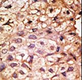 ACE2 / ACE-2 Antibody - Formalin-fixed and paraffin-embedded human cancer tissue reacted with the primary antibody, which was peroxidase-conjugated to the secondary antibody, followed by AEC staining. This data demonstrates the use of this antibody for immunohistochemistry; clinical relevance has not been evaluated. BC = breast carcinoma; HC = hepatocarcinoma.