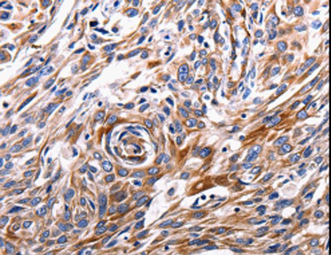 ACE2 / ACE-2 Antibody - Immunohistochemistry of paraffin-embedded Human lung cancer using ACE2 Polyclonal Antibody at dilution of 1:200.