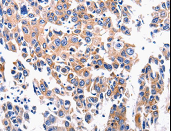 ACE2 / ACE-2 Antibody - Immunohistochemistry of paraffin-embedded Human lung cancer using ACE2 Polyclonal Antibody at dilution of 1:200.