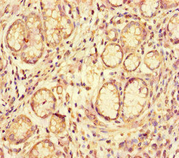 ACE2 / ACE-2 Antibody - Immunohistochemistry of paraffin-embedded human gastric cancer at dilution of 1:100