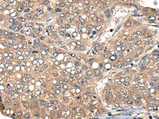 ACER1 / ASAH3 Antibody - Immunohistochemistry of paraffin-embedded Human liver cancer tissue  using ACER1 Polyclonal Antibody at dilution of 1:50(×200)