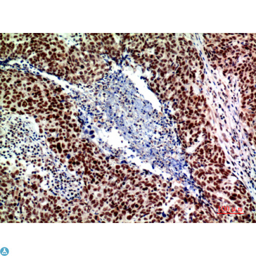 ACER2 Antibody - Immunohistochemistry (IHC) analysis of paraffin-embedded Human Breast Cancer, antibody was diluted at 1:200.