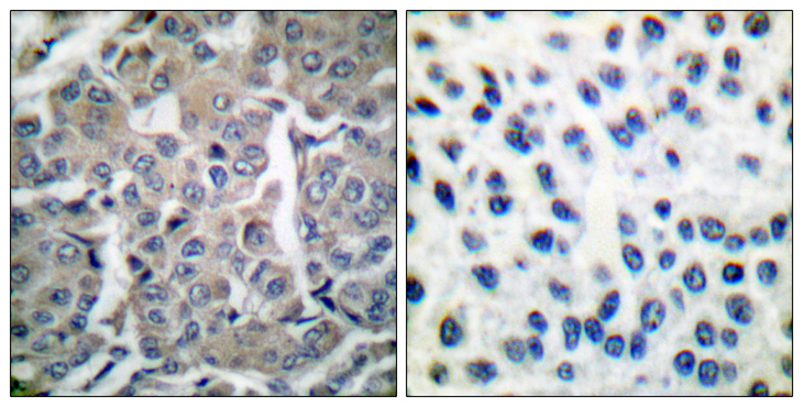 Acetyl-CoA Carboxylase / ACC Antibody - Immunohistochemistry analysis of paraffin-embedded human breast carcinoma tissue, using Acetyl-CoA Carboxylase Antibody. The picture on the right is blocked with the synthesized peptide.