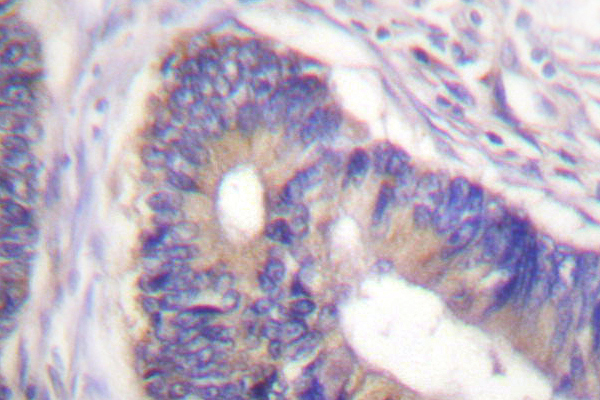 Acetyl-CoA Carboxylase / ACC Antibody - IHC of ACC (H74) pAb in paraffin-embedded human breast carcinoma colon carcinoma tissue.