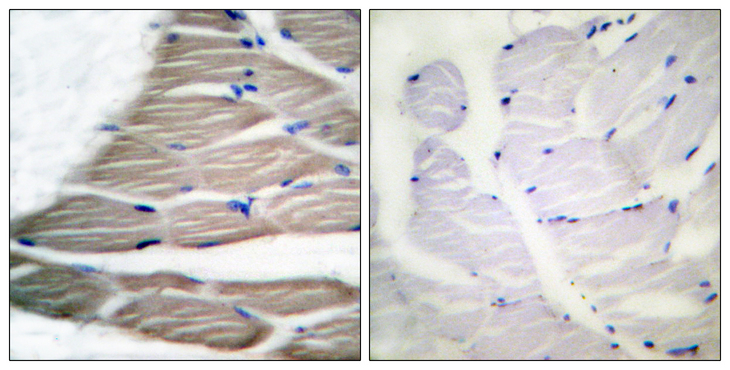 Acetyl-CoA Carboxylase / ACC Antibody - Immunohistochemistry analysis of paraffin-embedded human breast carcinoma, using ACC1 (Phospho-Ser80) Antibody. The picture on the right is blocked with the phospho peptide.