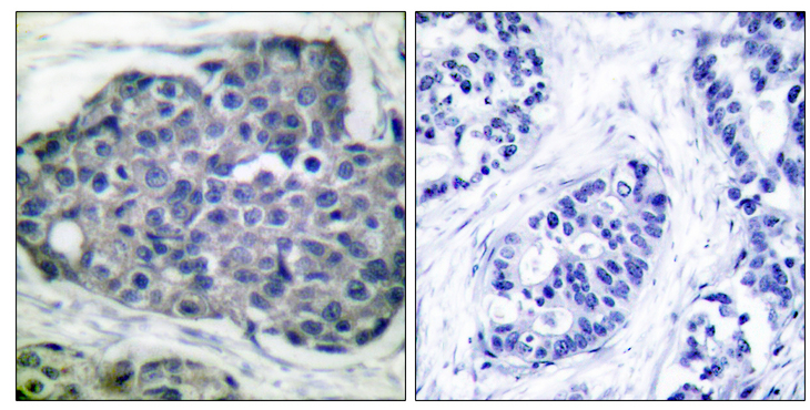Acetyl-CoA Carboxylase / ACC Antibody - Immunohistochemistry analysis of paraffin-embedded human breast carcinoma, using Acetyl-CoA Carboxylase (Phospho-Ser80) Antibody. The picture on the right is blocked with the phospho peptide.