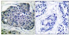 Acetyl-CoA Carboxylase / ACC Antibody - Immunohistochemistry analysis of paraffin-embedded human breast carcinoma, using Acetyl-CoA Carboxylase (Phospho-Ser80) Antibody. The picture on the right is blocked with the phospho peptide.