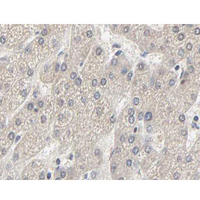 Acetyl-CoA Carboxylase / ACC Antibody - 1:200 staining human liver carcinoma tissues by IHC-P. The tissue was formaldehyde fixed and a heat mediated antigen retrieval step in citrate buffer was performed. The tissue was then blocked and incubated with the antibody for 1.5 hours at 22°C. An HRP conjugated goat anti-rabbit antibody was used as the secondary.