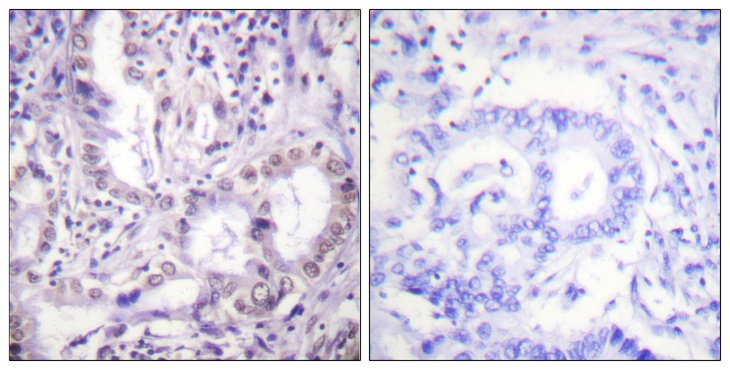 Acetyl-Lysine Antibody - Immunohistochemistry analysis of paraffin-embedded human lung carcinoma, using Lys-Acetylated Proteins Antibody. The picture on the right is blocked with the synthesized peptide.