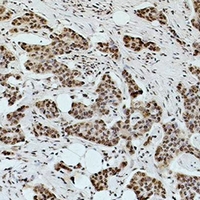 Acetyl-Lysine Antibody - Immunohistochemical analysis of Acetyl Lysine staining in human breast cancer formalin fixed paraffin embedded tissue section. The section was pre-treated using heat mediated antigen retrieval with sodium citrate buffer (pH 6.0). The section was then incubated with the antibody at room temperature and detected using an HRP conjugated compact polymer system. DAB was used as the chromogen. The section was then counterstained with hematoxylin and mounted with DPX.