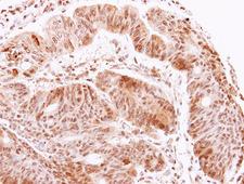 ACHE / Acetylcholinesterase Antibody - AChE antibody detects ACHE protein at cytoplasm on colon carcinoma by immunohistochemical analysis. Sample: Paraffin-embedded colon carcinoma. AChE antibody dilution:1:500.
