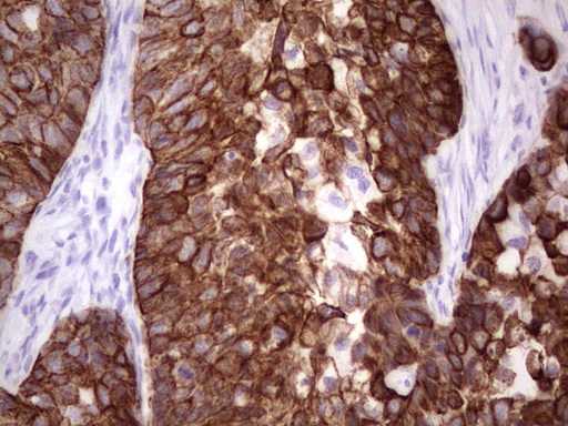 Acidic Cytokeratin AE1 Antibody - IHC of paraffin-embedded Carcinoma of Human kidney tissue using anti-Acidic Cytokeratin mouse monoclonal antibody.