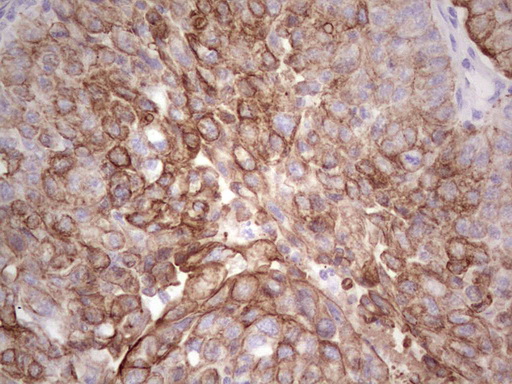 Acidic Cytokeratin AE1 Antibody - IHC of paraffin-embedded Carcinoma of Human lung tissue using anti-Acidic Cytokeratin mouse monoclonal antibody.