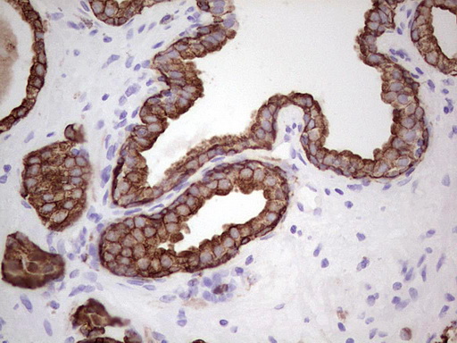 Acidic Cytokeratin AE1 Antibody - IHC of paraffin-embedded Carcinoma of Human prostate tissue using anti-Acidic Cytokeratin mouse monoclonal antibody.