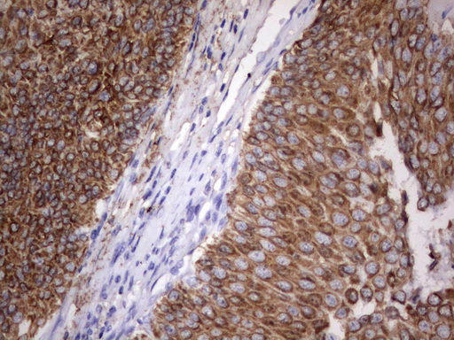 Acidic Cytokeratin Antibody - IHC of paraffin-embedded Carcinoma of Human bladder tissue using anti-Acidic CK rat monoclonal antibody.