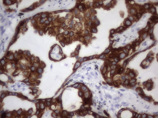 Acidic Cytokeratin Antibody - IHC of paraffin-embedded Carcinoma of Human lung tissue using anti-Acidic CK mouse monoclonal antibody.