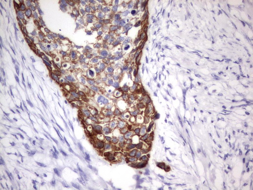 Acidic Cytokeratin Antibody - IHC of paraffin-embedded Carcinoma of Human kidney tissue using anti-Acidic CK rat monoclonal antibody.