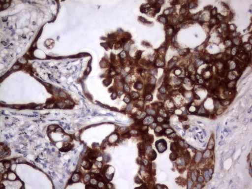 Acidic Cytokeratin Antibody - IHC of paraffin-embedded Carcinoma of Human lung tissue using anti-Acidic CK rat monoclonal antibody.