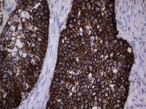 Acidic Cytokeratin Antibody - IHC of paraffin-embedded Carcinoma of Human kidney tissue using anti-Acidic CK rat monoclonal antibody.