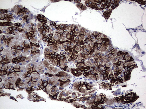 Acidic Cytokeratin Antibody - IHC of paraffin-embedded Carcinoma of Human pancreas tissue using anti-Acidic CK rat monoclonal antibody.