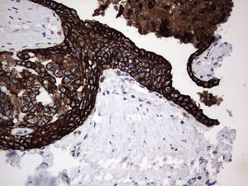Acidic Cytokeratin Antibody - IHC of paraffin-embedded Carcinoma of Human prostate tissue using anti-Acidic CK rat monoclonal antibody.